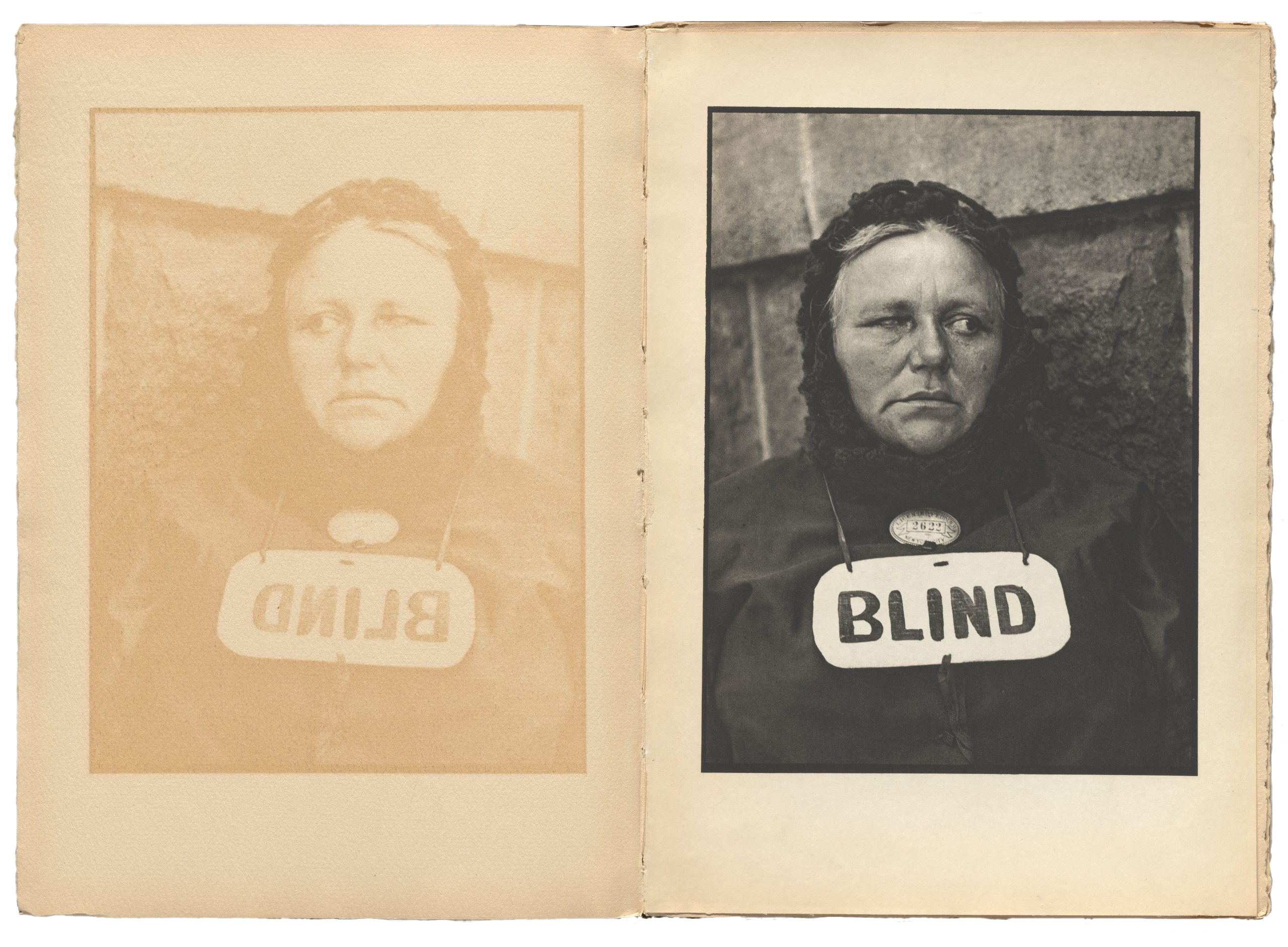 Black and white photograph of a woman missing her left eye wearing a sign with written BLIND in all capital, bold letters